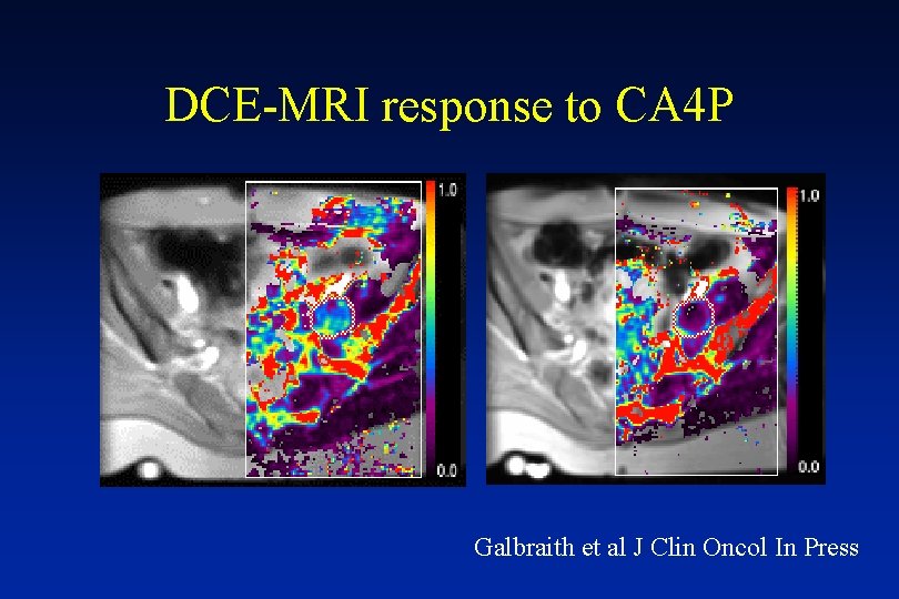 DCE-MRI response to CA 4 P Galbraith et al J Clin Oncol In Press