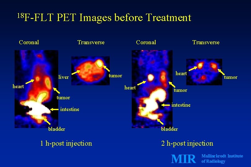 18 F-FLT PET Images before Treatment Coronal Transverse liver heart Coronal Transverse heart tumor