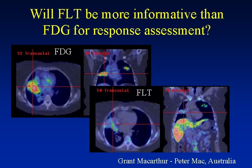 Will FLT be more informative than FDG for response assessment? FDG FLT Grant Macarthur