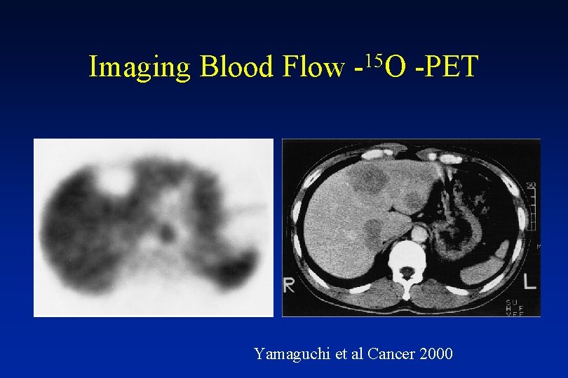 Imaging Blood Flow 15 - O -PET Yamaguchi et al Cancer 2000 