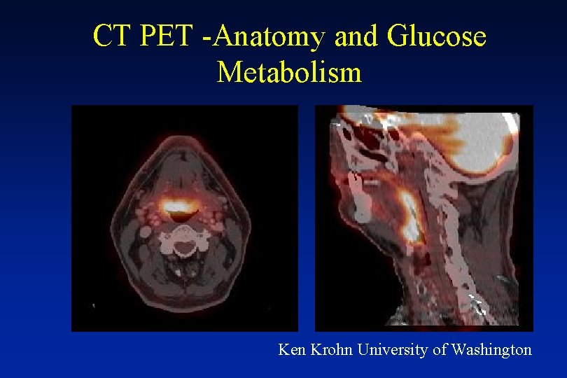 CT PET -Anatomy and Glucose Metabolism Ken Krohn University of Washington 