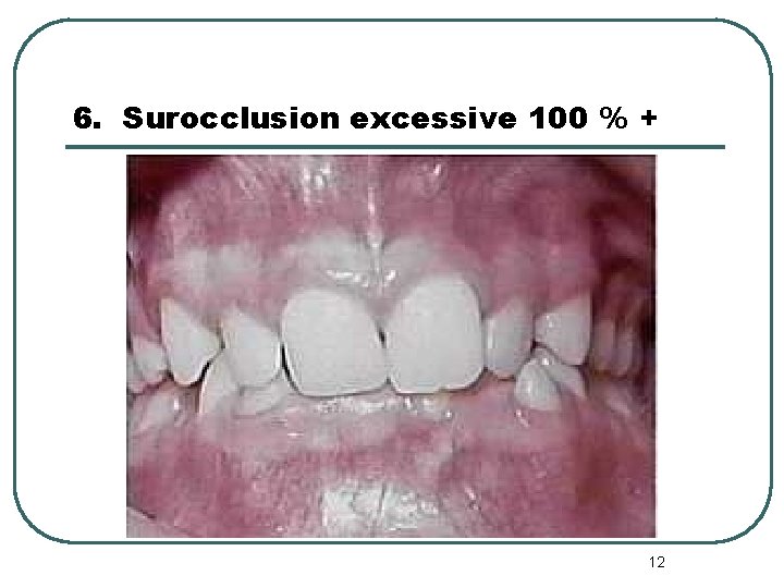 6. Surocclusion excessive 100 % + 12 