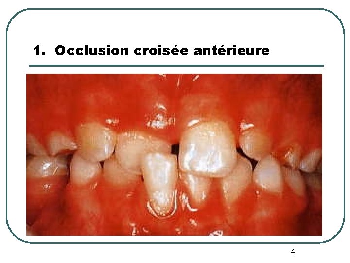 1. Occlusion croisée antérieure 4 