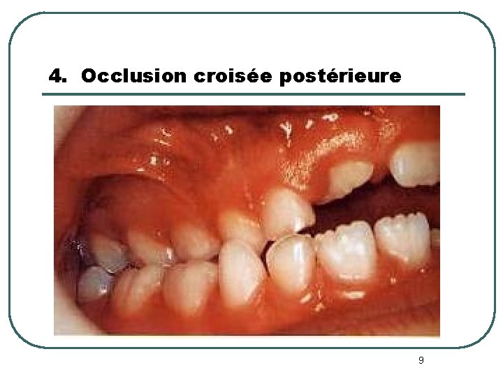 4. Occlusion croisée postérieure 9 