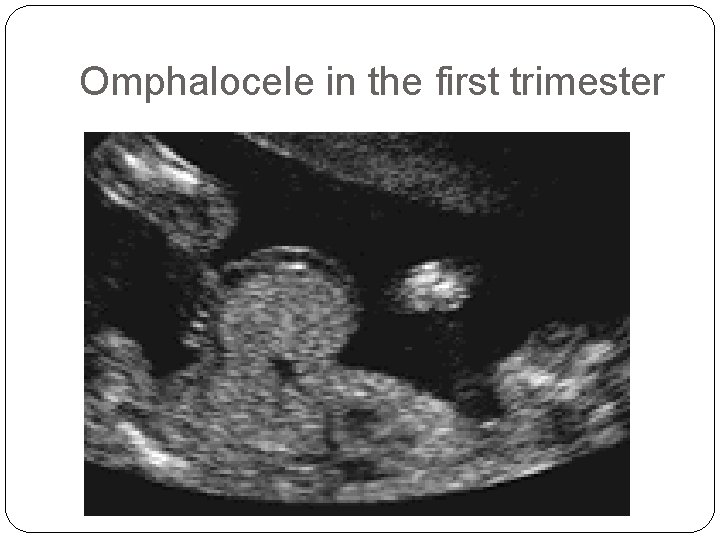 Omphalocele in the first trimester 