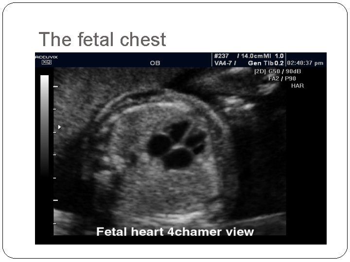 The fetal chest 