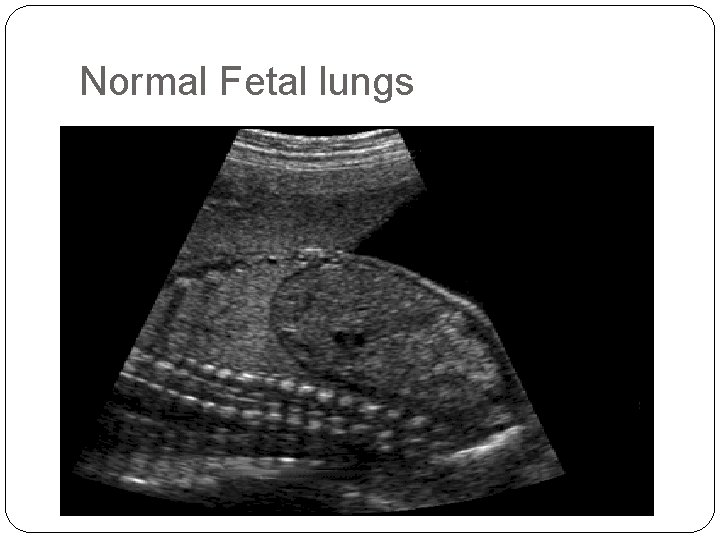 Normal Fetal lungs 