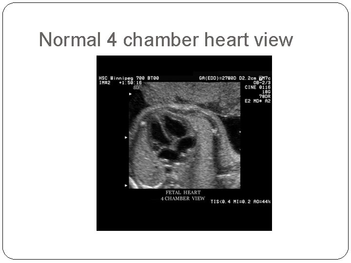 Normal 4 chamber heart view 