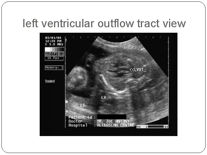 left ventricular outflow tract view 