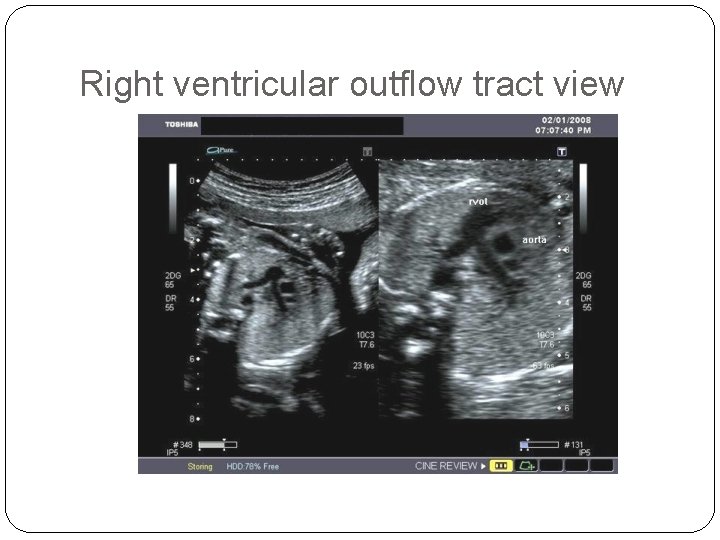 Right ventricular outflow tract view 