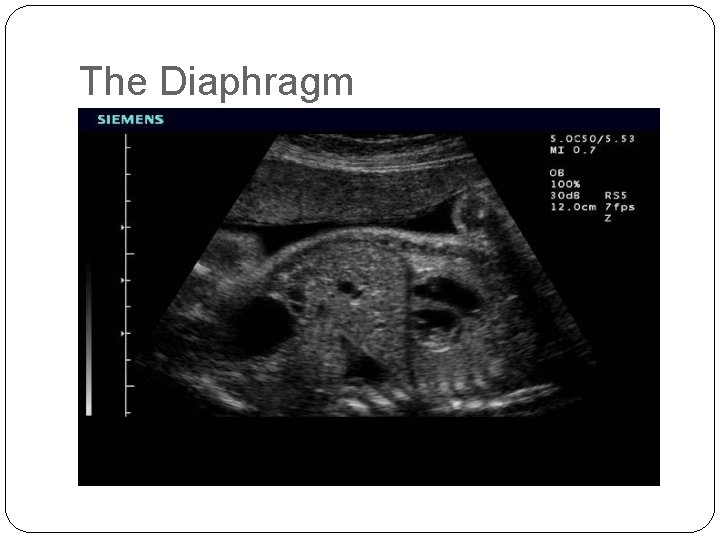 The Diaphragm 