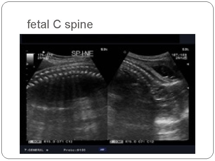 fetal C spine 