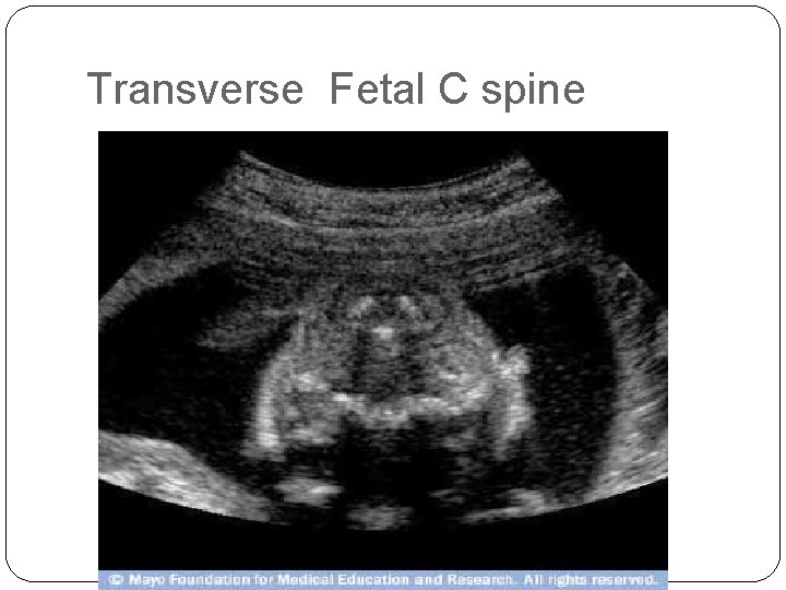 Transverse Fetal C spine 