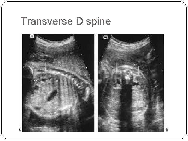 Transverse D spine 