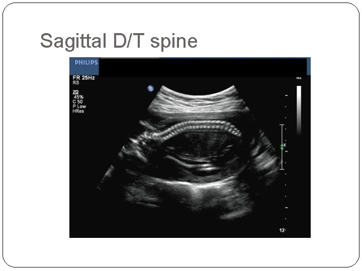 Sagittal D/T spine 
