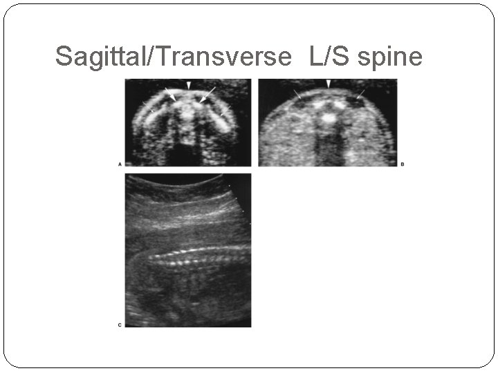 Sagittal/Transverse L/S spine 