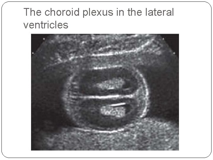 The choroid plexus in the lateral ventricles 