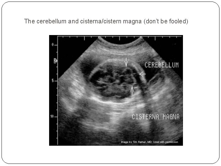 The cerebellum and cisterna/cistern magna (don’t be fooled) 