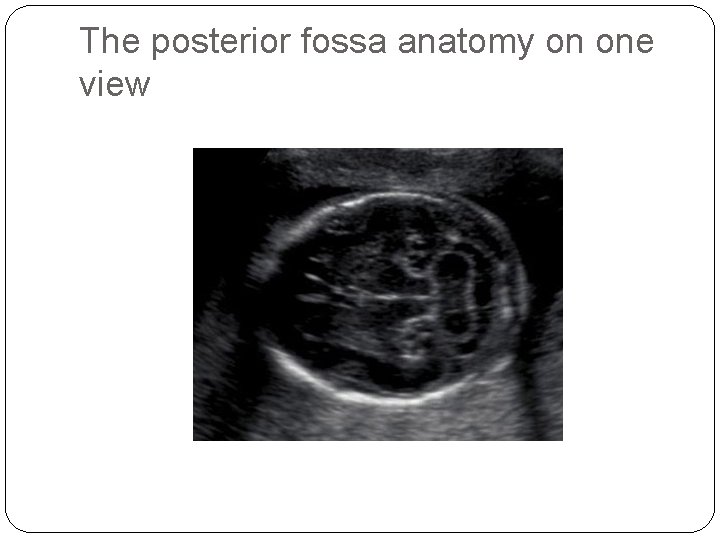 The posterior fossa anatomy on one view 