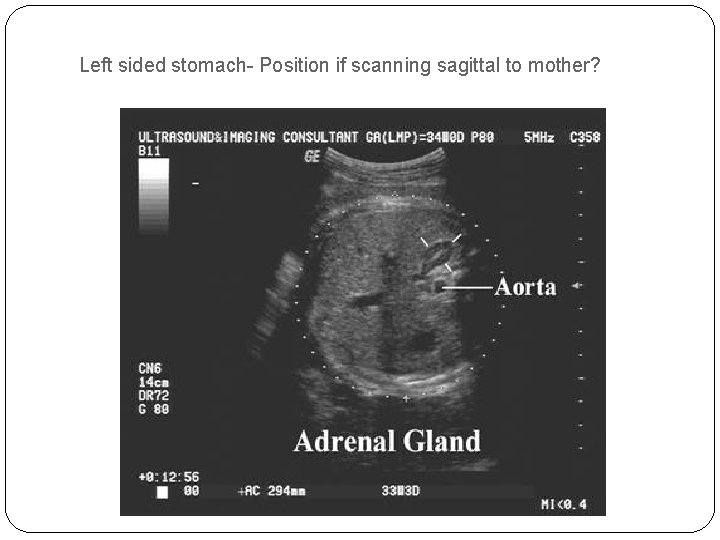 Left sided stomach- Position if scanning sagittal to mother? 