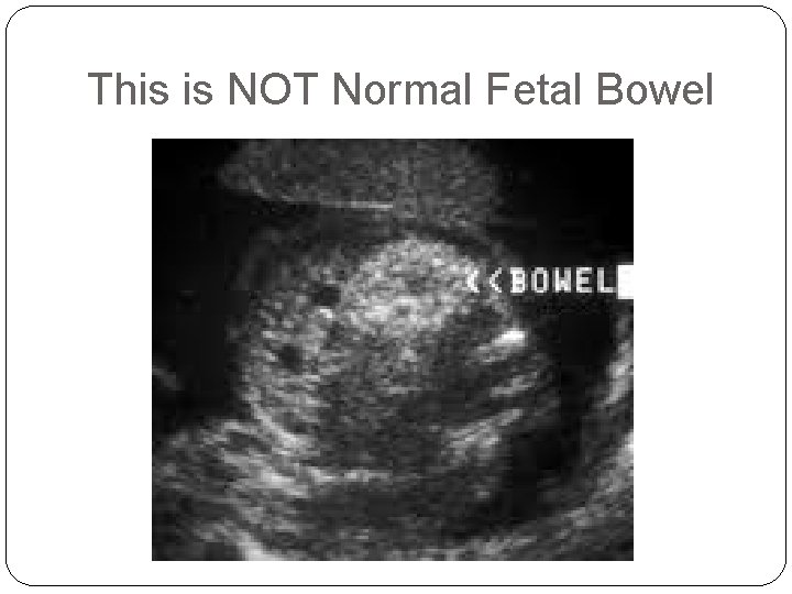 This is NOT Normal Fetal Bowel 