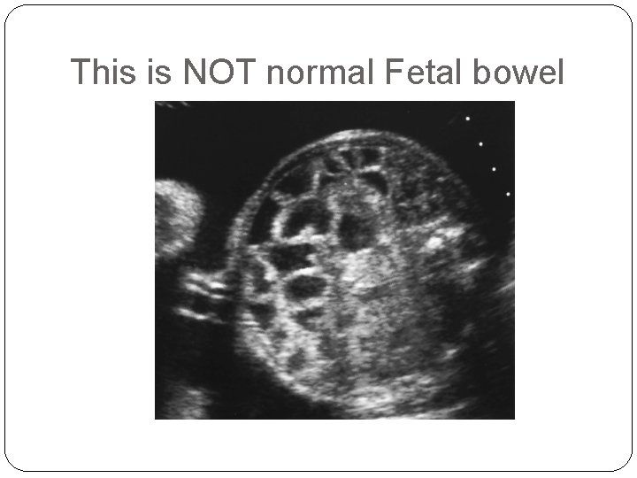 This is NOT normal Fetal bowel 