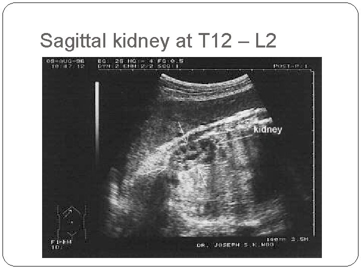 Sagittal kidney at T 12 – L 2 