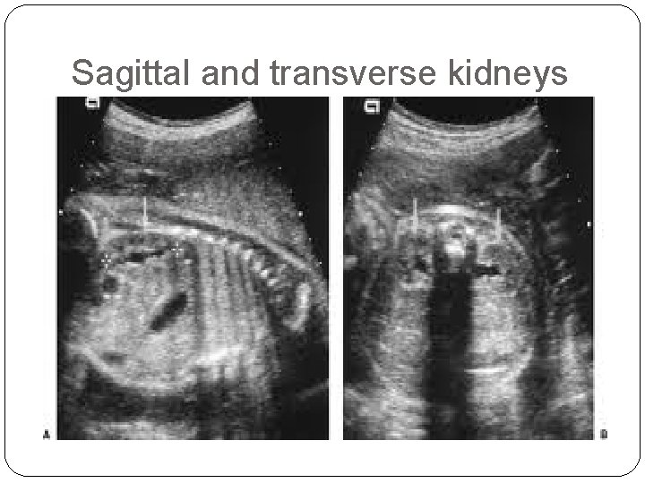 Sagittal and transverse kidneys 