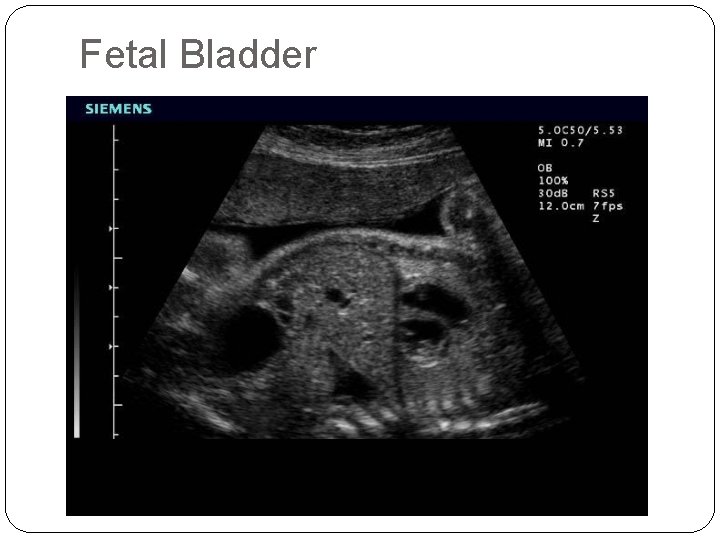 Fetal Bladder 