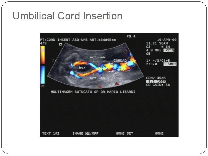 Umbilical Cord Insertion 