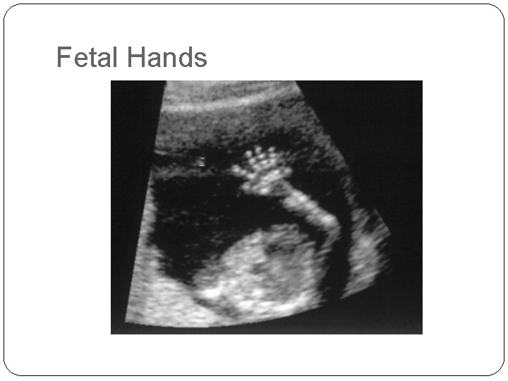 Fetal Hands 