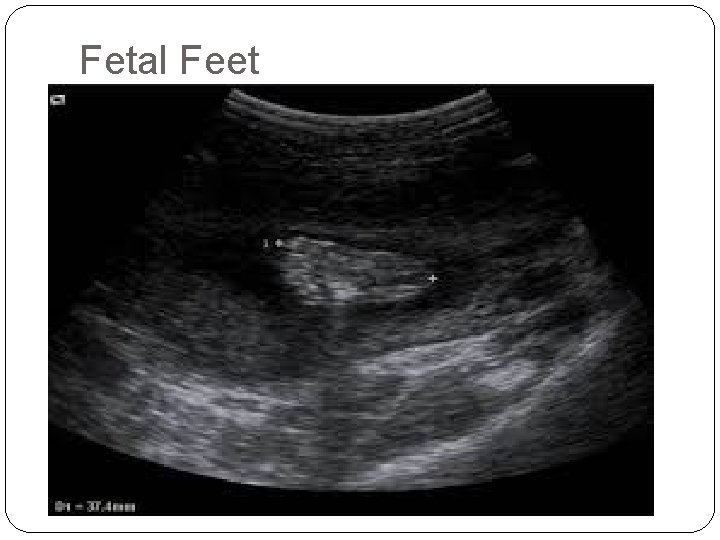 Fetal Feet 