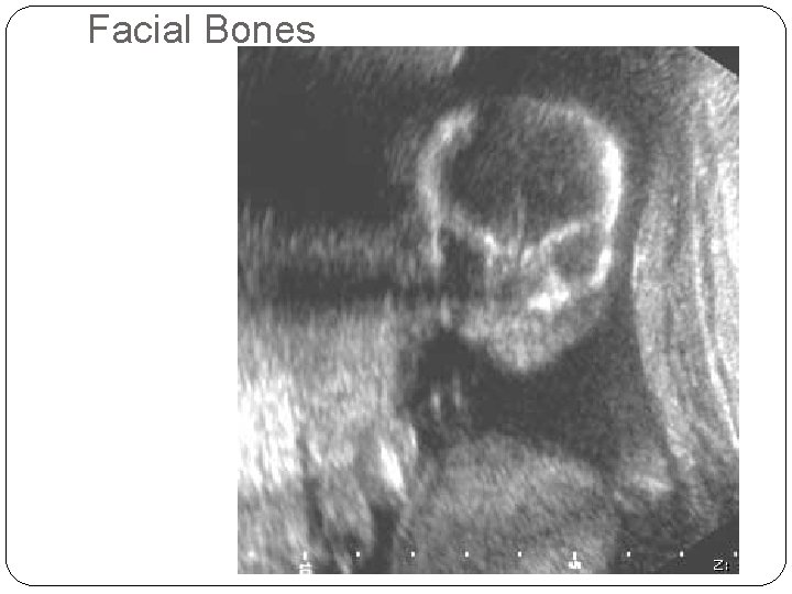 Facial Bones 