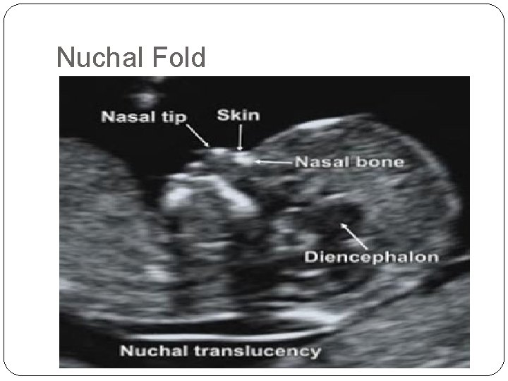 Nuchal Fold 