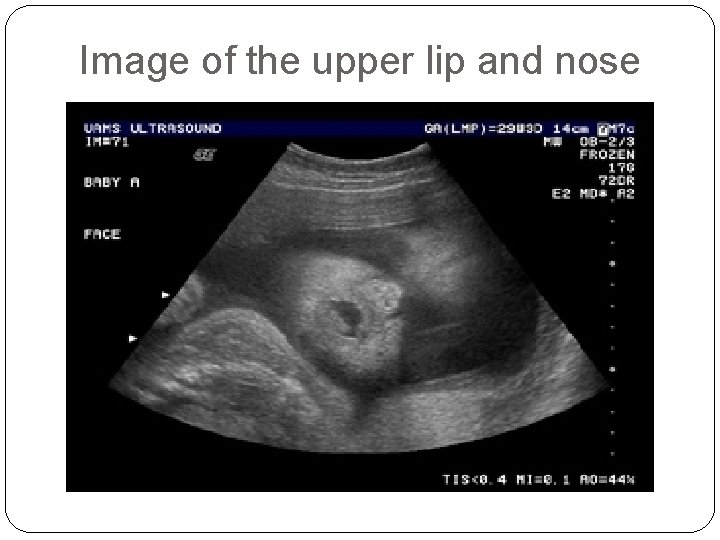 Image of the upper lip and nose 