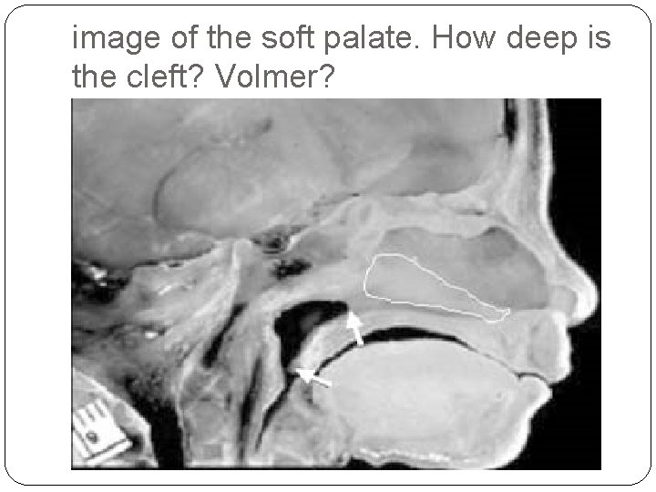 image of the soft palate. How deep is the cleft? Volmer? 