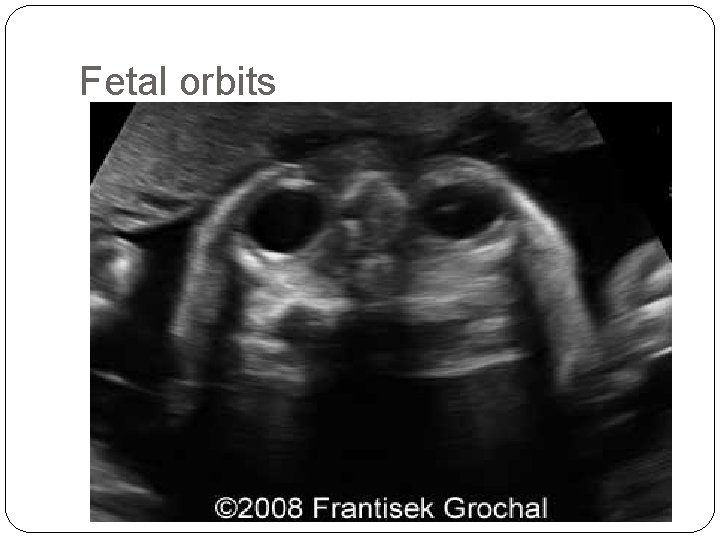 Fetal orbits 