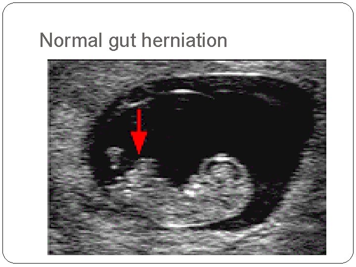 Normal gut herniation 