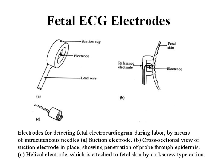 Fetal ECG Electrodes for detecting fetal electrocardiogram during labor, by means of intracutaneous needles