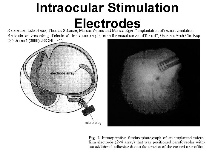 Intraocular Stimulation Electrodes Reference : Lutz Hesse, Thomas Schanze, Marcus Wilms and Marcus Eger,