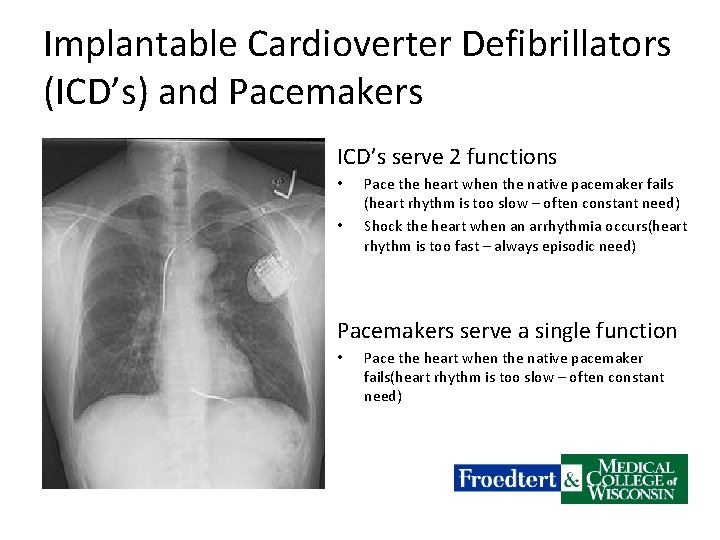 Implantable Cardioverter Defibrillators (ICD’s) and Pacemakers ICD’s serve 2 functions • • Pace the