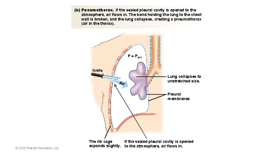 Pneumothorax. If the sealed pleural cavity is opened to the atmosphere, air flows in.