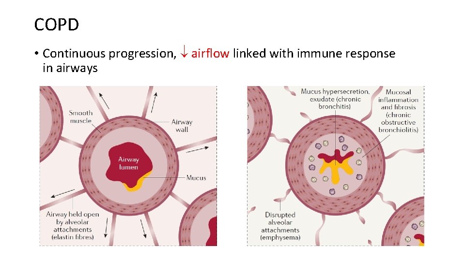 COPD • Continuous progression, airflow linked with immune response in airways 