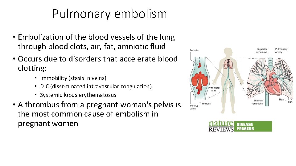 Pulmonary embolism • Embolization of the blood vessels of the lung through blood clots,