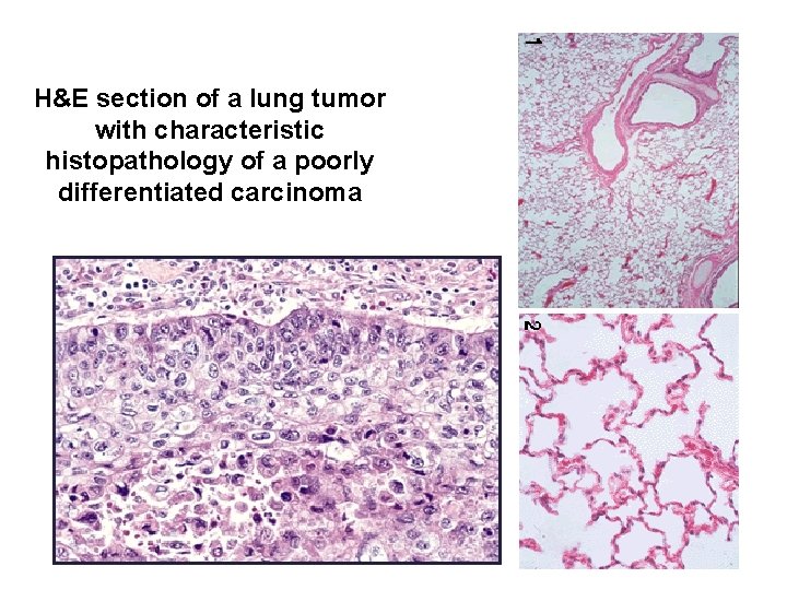 H&E section of a lung tumor with characteristic histopathology of a poorly differentiated carcinoma