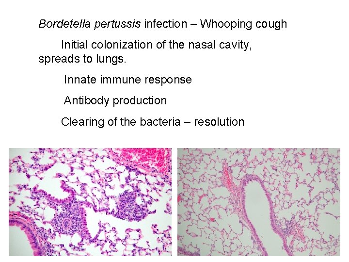 Bordetella pertussis infection – Whooping cough Initial colonization of the nasal cavity, spreads to