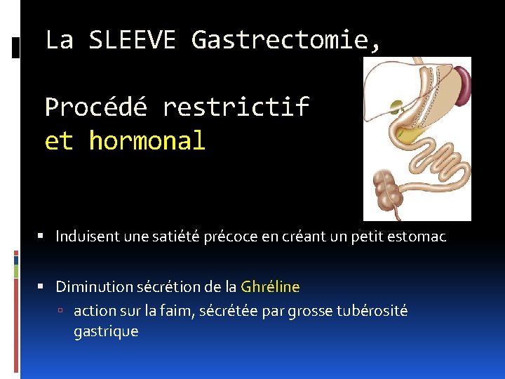 La SLEEVE Gastrectomie, Procédé restrictif et hormonal Induisent une satiété précoce en créant un