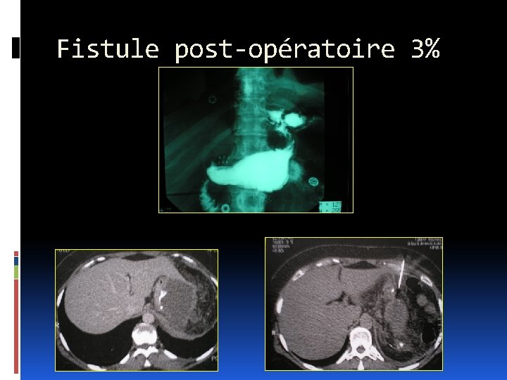 Fistule post-opératoire 3% 