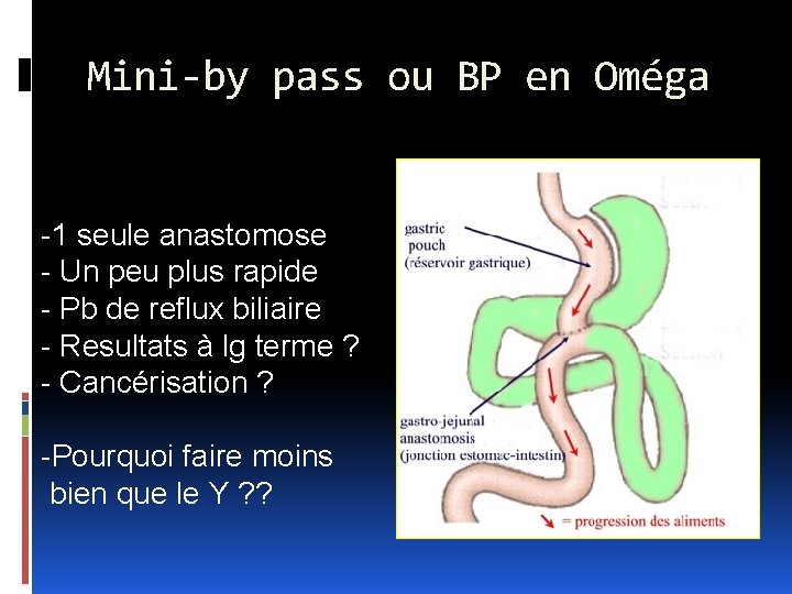 Mini-by pass ou BP en Oméga -1 seule anastomose - Un peu plus rapide