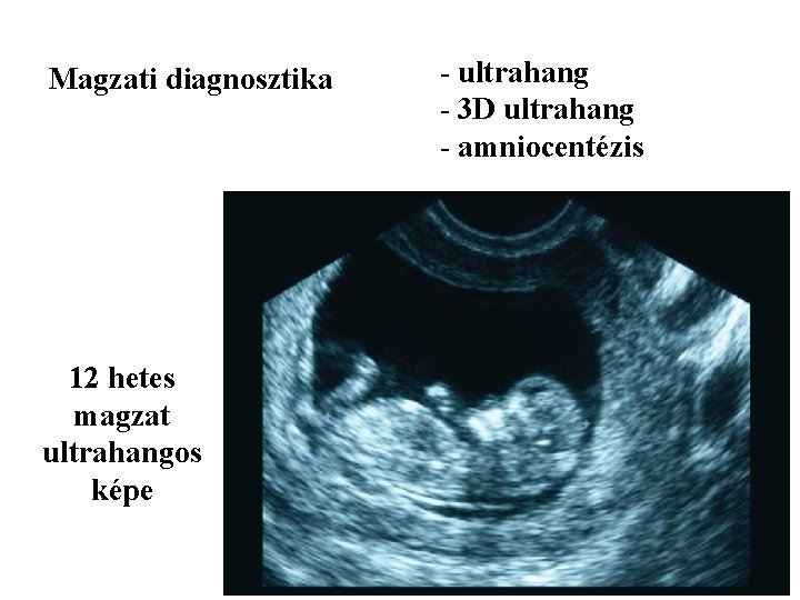 Magzati diagnosztika 12 hetes magzat ultrahangos képe - ultrahang - 3 D ultrahang -